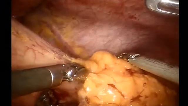 Robotic gastric bypass (Роботическое желудочное шунтирование) смотреть онлайн
