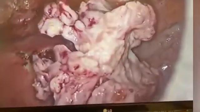 MIOMAS GRANDES POR VIDEOLAPAROSCOPIA смотреть онлайн