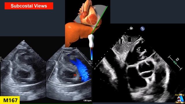 Pediatric Echo : Patent Ductus Arteriosus (PDA) смотреть онлайн