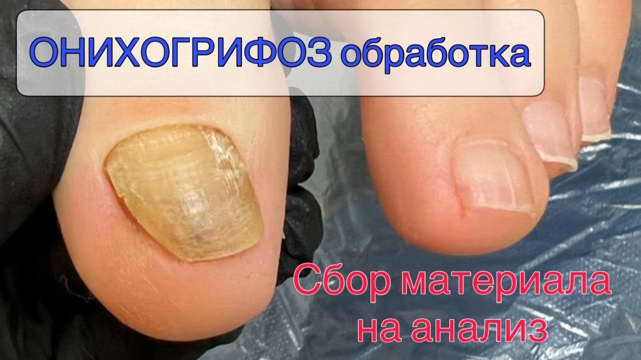 😱Онихогрифоз _ грибок ногтей _ скрученные ногти