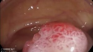 Удаление полипа толстой кишки с наложением эндоскопической клипсы.