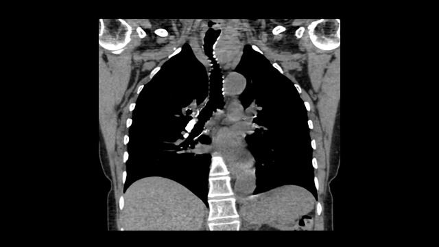CT of the hilum смотреть онлайн
