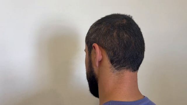 25 ДЕНЬ ПОСЛЕ ПЕРЕСАДКИ ВОЛОС ! 90% ВОЛОС ВЫПАЛО. смотреть онлайн