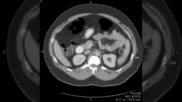 Annular Pancreas смотреть онлайн