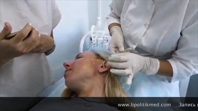 Постановка мезонитей COG