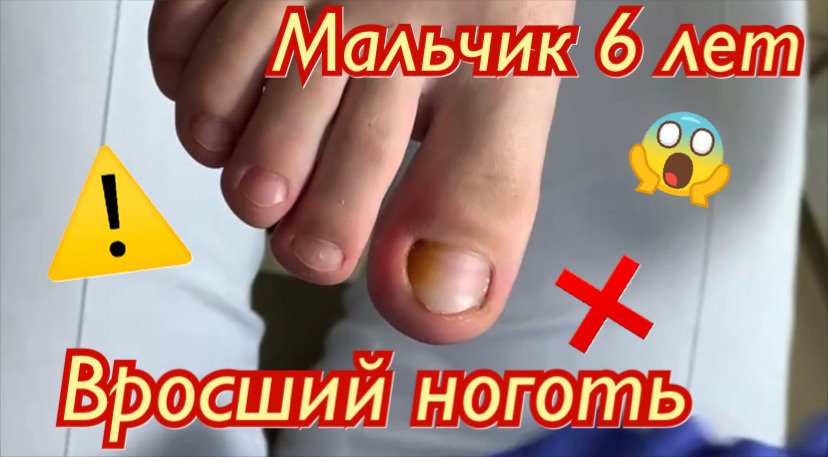 Мальчик 6 лет⚠️?❗️ • Вросший ноготь???? смотреть онлайн