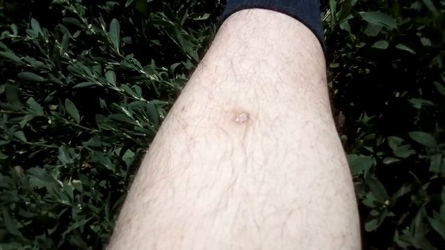 После укуса клеща. Спустя 50 дней смотреть онлайн