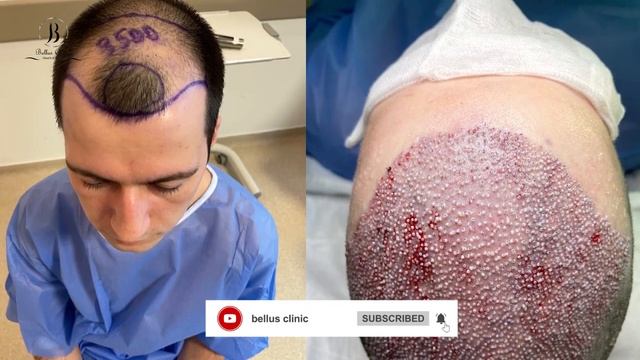 Hair Transplant In Bellus Clinic