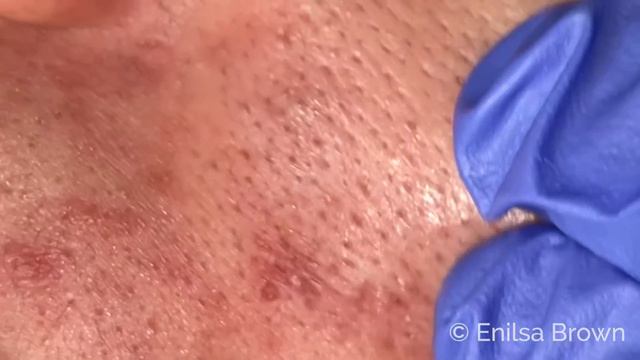 Happy Holidays! Blackhead Extractions On Our Dear Friend Julie 🥰