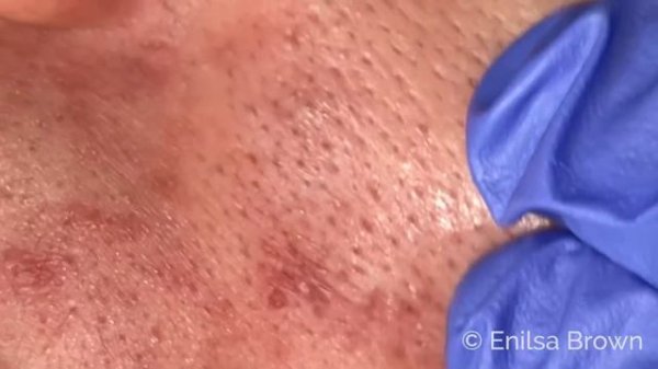 Happy Holidays! Blackhead extractions on our dear friend Julie 🥰