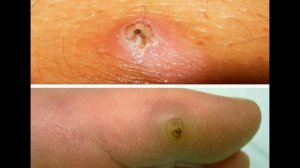 Чем Опасны Укусы Блох и Как их Лечить