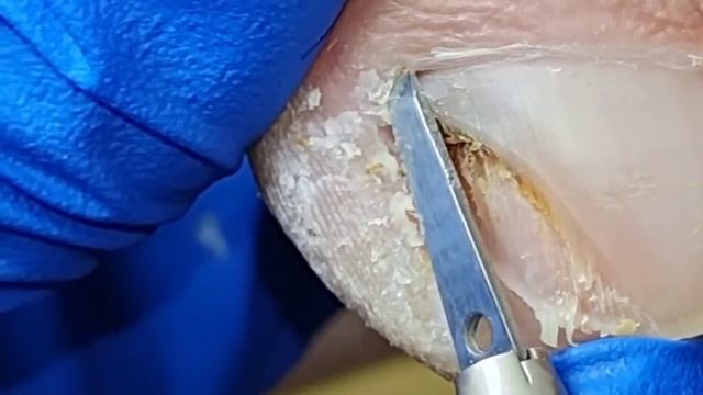 Damp black dirt under the ingrown nails!【Xue Yidao】 смотреть онлайн