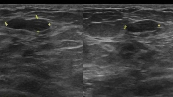 ЛЕКЦИЯ 6. BI-RADS - ПРОСТО О СЛОЖНОМ.