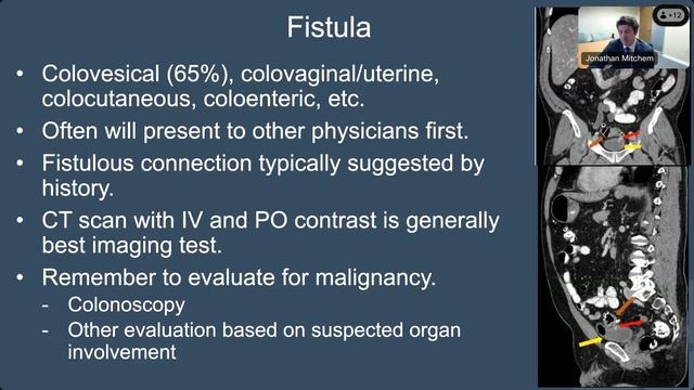 Diverticulitis Update 2023 смотреть онлайн