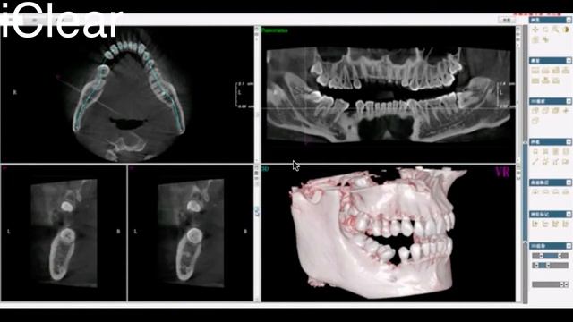 CHX-X90DPro-2DE Dental OPG with Ceph able to updated to CT смотреть онлайн