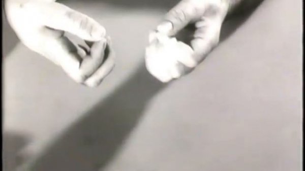 Полинейропатический синдром © Polyneuropathic Syndrome