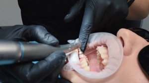 Снятие брекетов