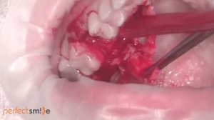 Пластика ороантрального соустья. VIP-CT