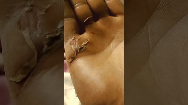 Лечение рваной раны на руке: день десятый