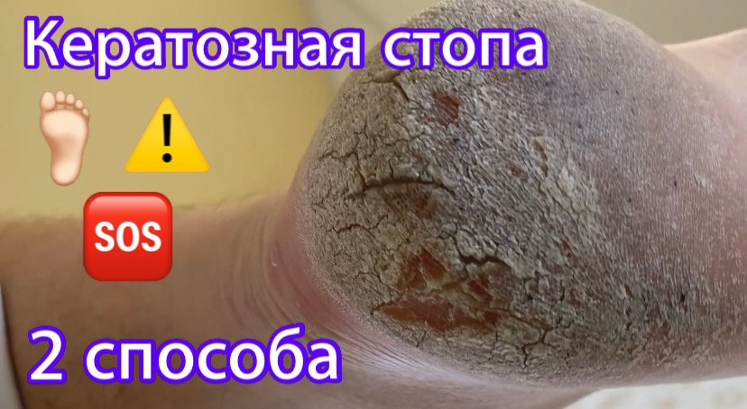 Кератоз стопы❗️⚠️?? смотреть онлайн