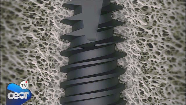 Instalación de Implante Dental [Animación 3D] смотреть онлайн