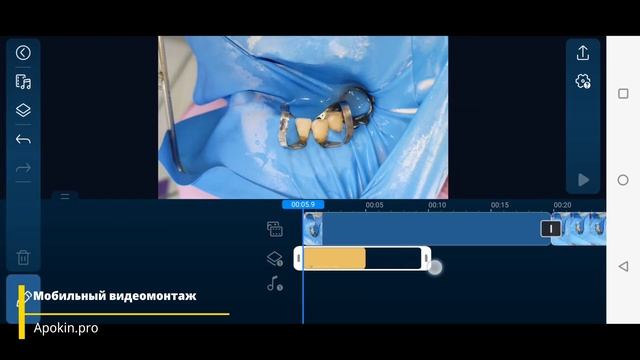 Мобильный видео-монтаж клинического примера Nictone CyberLink PowerDirector 9.2.1 на Android 11(4K) смотреть онлайн