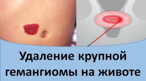 Удаление крупной гемангиомы на животе