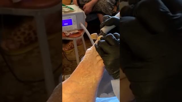 Онихогрифоз у бабушки / Что с ногтями? Длинные толстые ногти, как стричь? смотреть онлайн