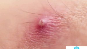 фурункул хакида малумот