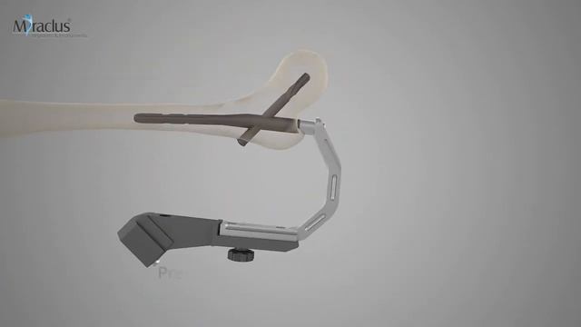 БИОС чрезвертельного перелома бедренной кости Gamma стержнем. Анимация. смотреть онлайн
