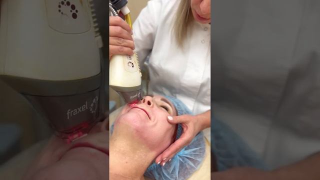 Процедура Fraxel с wow-эффектом в конце видео. Ника Спринг. смотреть онлайн