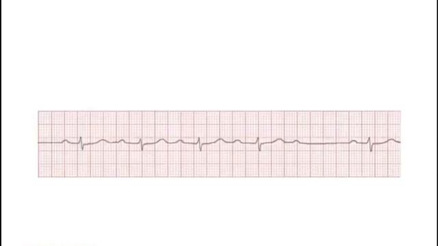 ECG BASICS 7 PR INTERVAL PART 1 NORMAL PR AND AV NODAL BLOCK смотреть онлайн