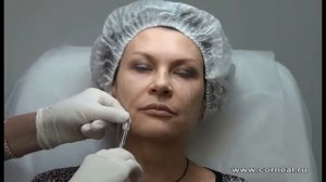 Учимся работать канюлей