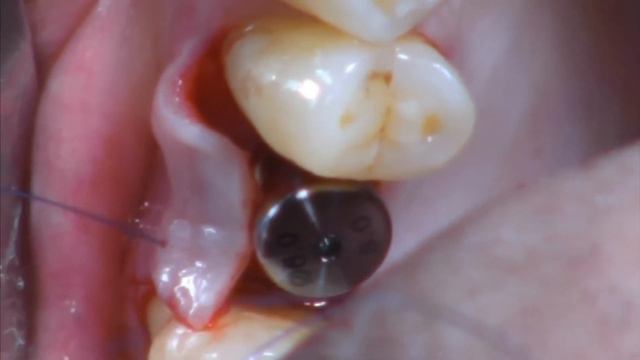 Установка дентального имплантанта (врач-стоматолог хирург Гиноян Т.М.) смотреть онлайн