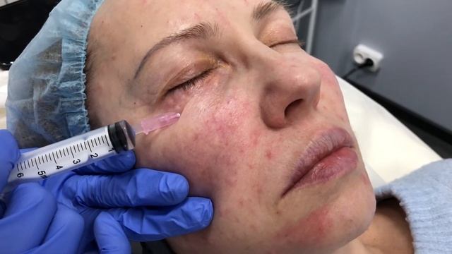 Инъекции Dermaheal EyeBag Solution - обзор процедуры, уколы для омоложения кожи вокруг глаз