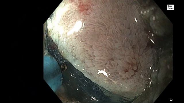 Удаление латерально распрастраняющейся опухоли ДПК методом ESD смотреть онлайн