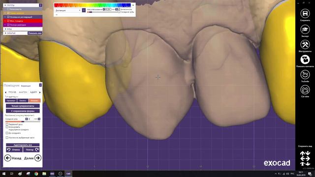 Хитрости работы в Exocad смотреть онлайн