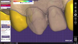 Хитрости работы в Exocad