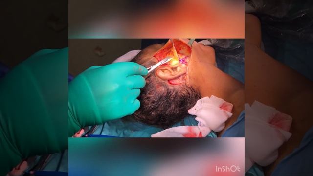 High smas face lift смотреть онлайн