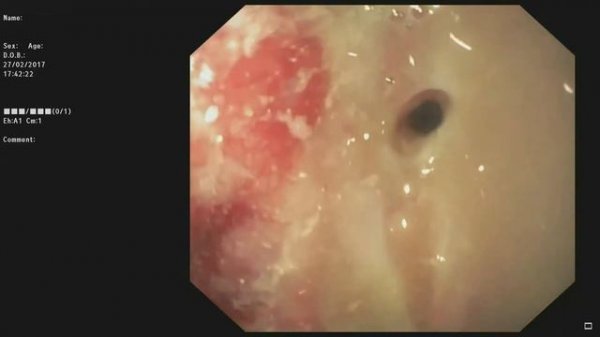 Цистогастростомия с транслюминальной некрсеквестрэктомией