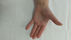 Стенозирующий лигаментит 1 пальца левой кисти.