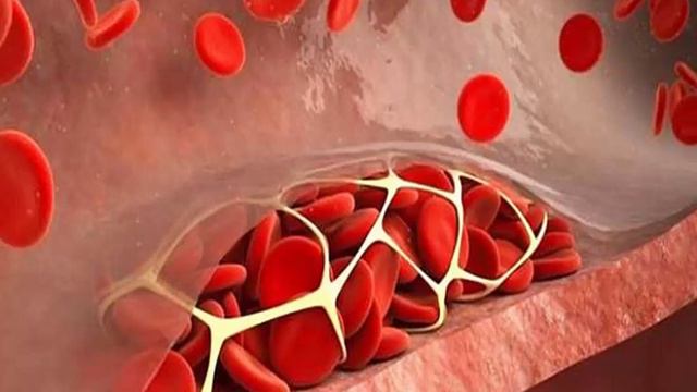 Легкий способ: как узнать что у вас есть тромбы и как их лечить при помощи минифлебэктомии смотреть онлайн