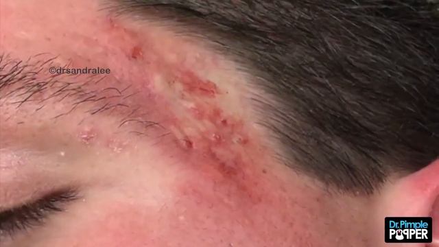 Acne Vulgaris and Extracting large Whiteheads - Part 1 смотреть онлайн