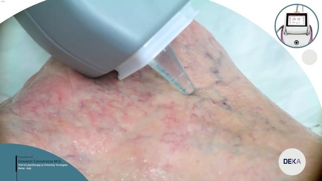 DEKA Luxea - Nd YAG Sparks Vascular Lesion Treatment смотреть онлайн