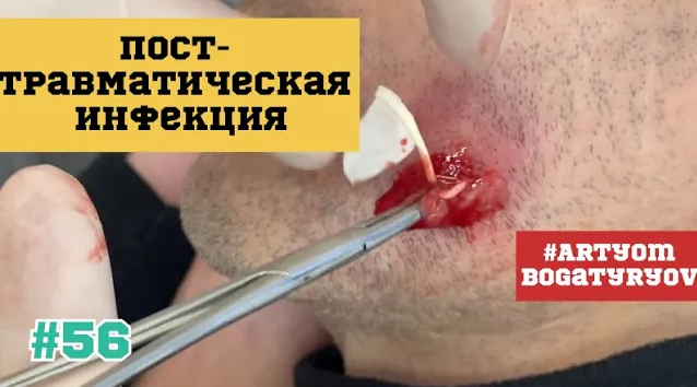 56. ГНОЙ идёт в полость РТА! БЫСТРО и эффективно