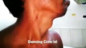 Пляска каротид