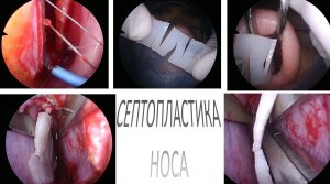 Септопластика перегородки носа с экстракорпоральным моделированием аутохряща ЛОР операция Лор-хирург