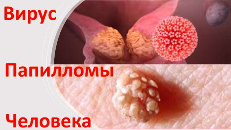 Вирус папилломы человека смотреть онлайн