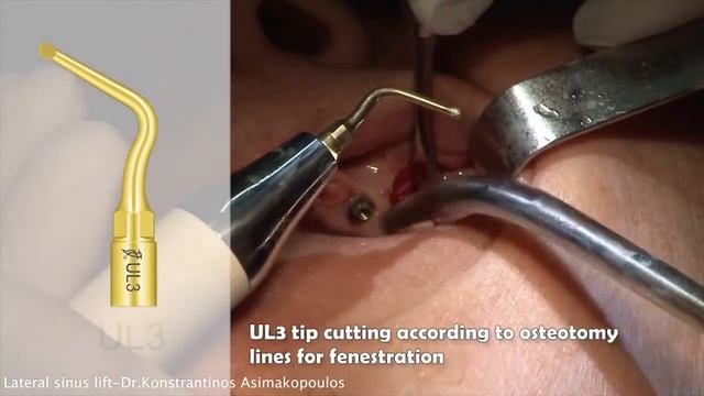 Ultrasurgery DS-II LED - ультразвуковой хирургический аппарат с оптикой | Woodpecker (Китай) смотреть онлайн