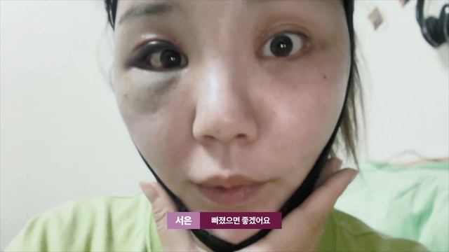 첫 성형으로 '이마 거상?' 전후비교 회복과정 쌩 리얼 후기 - 결혼준비 브이로그??♀️ смотреть онлайн